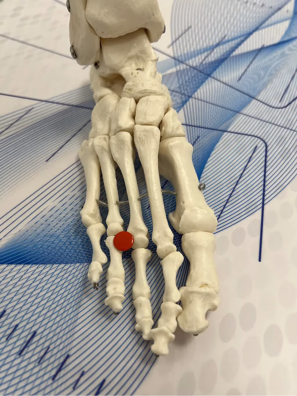 Tratamiento especializado para neuroma de Morton y dolor entre los dedos