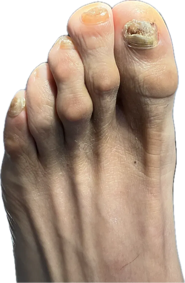 Onicomicosis asociada a dermatomicosis: hongos que migran de la piel a la uña del pie