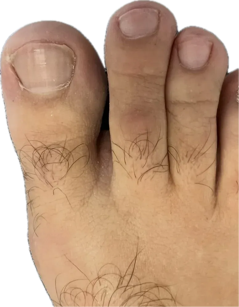 Evolución de las uñas de los pies durante el seguimiento de la onicomicosis tratada con láser: uñas del dedo gordo y del segundo dedo más claras y lisas