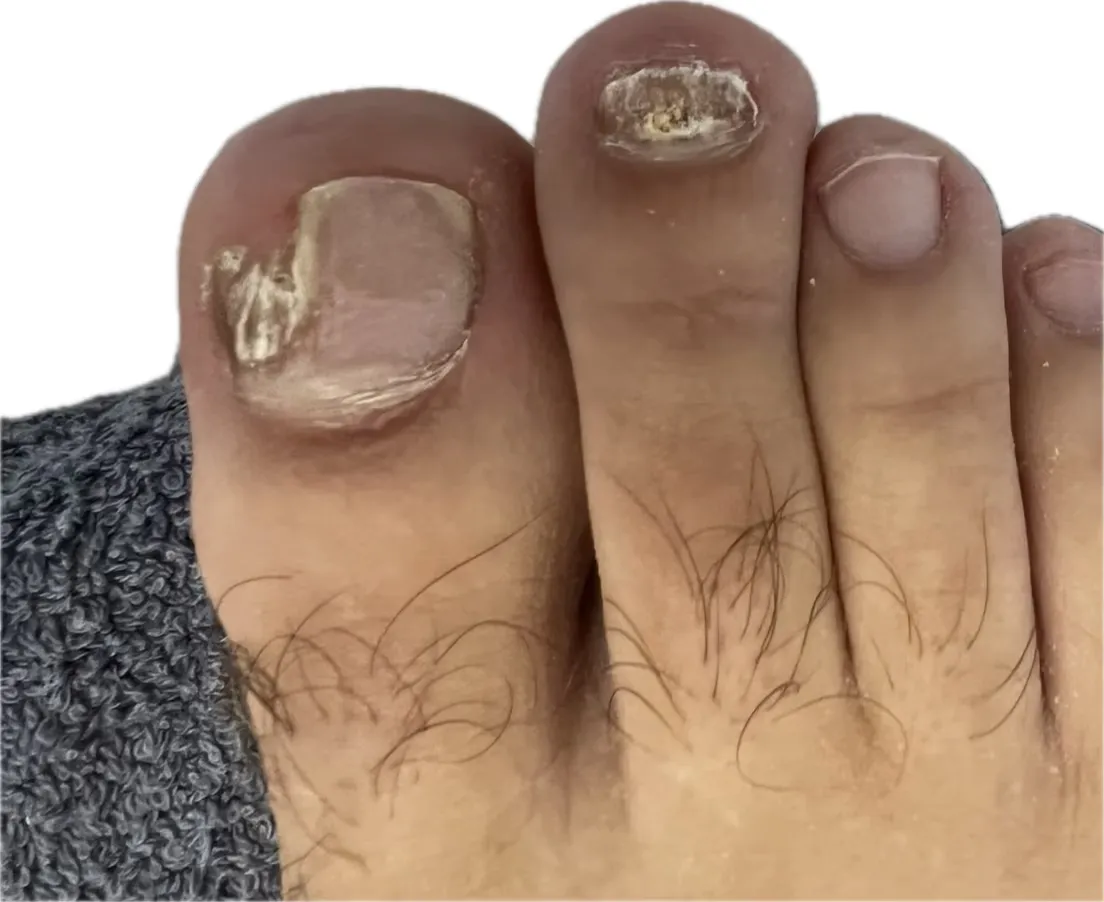 Uñas de los pies con onicomicosis antes del tratamiento láser: zona engrosada y amarillenta en el dedo gordo y uña del segundo dedo desestructurada