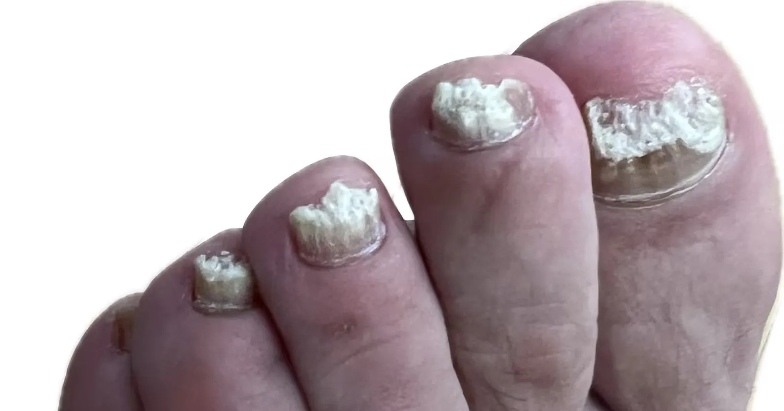 Uñas del pie engrosadas, blanquecinas y desmenuzadas por una onicomicosis mixta, antes del tratamiento en Centro Podológico Henao Bilbao