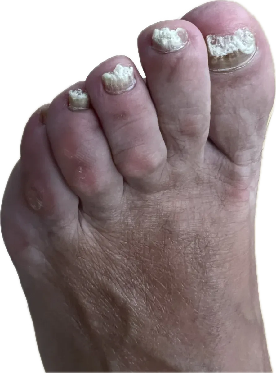 Varias uñas del pie engrosadas, blanquecinas y desmenuzadas por una onicomicosis mixta