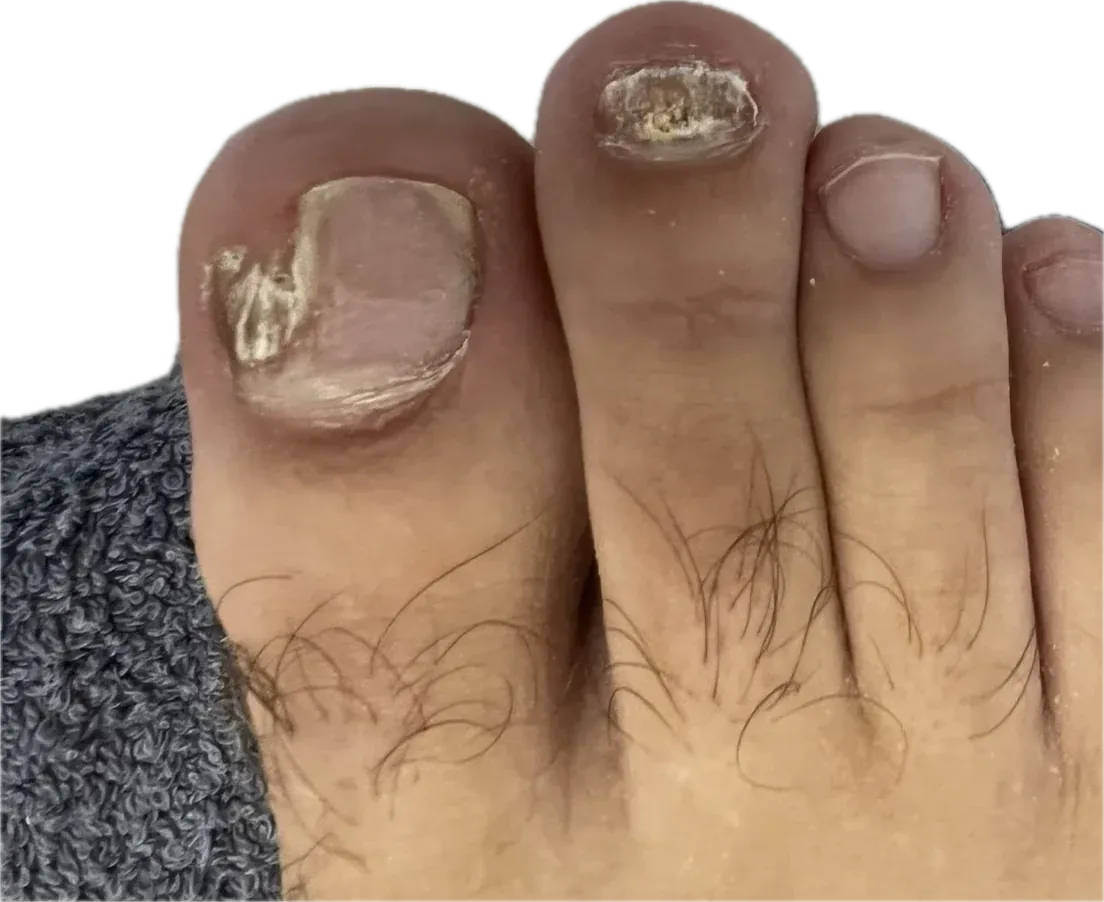 Uñas de los pies con onicomicosis antes del tratamiento: zona engrosada y amarillenta en el borde de la uña del dedo gordo y uña del segundo dedo desestructurada