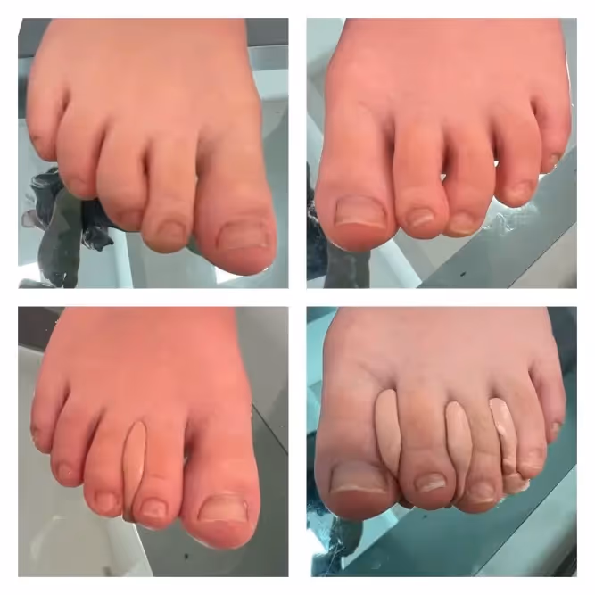 Podología infantil para dolor de talón en niños en Bilbao