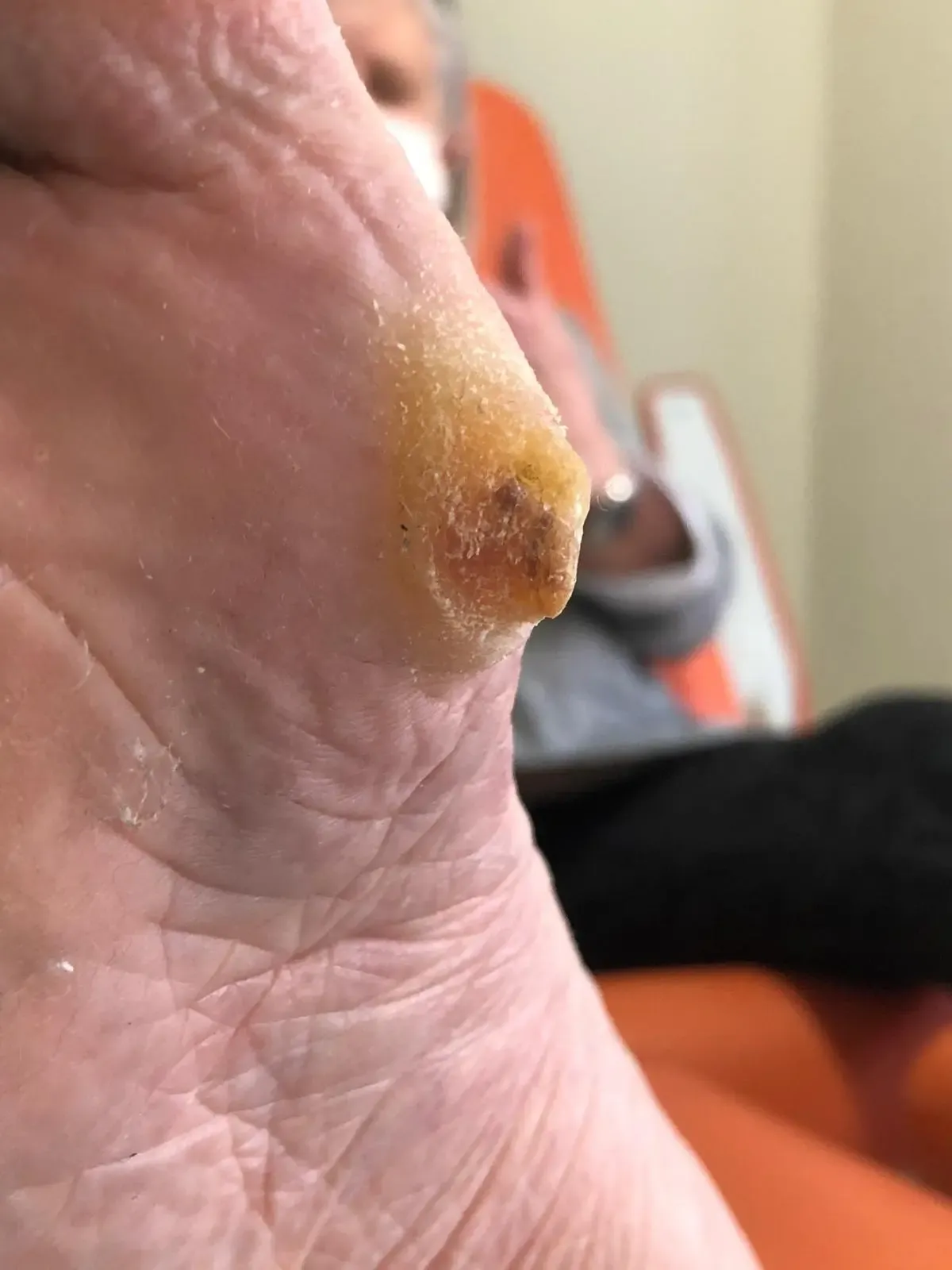 Evolución del tratamiento de queratosis plantar intratable