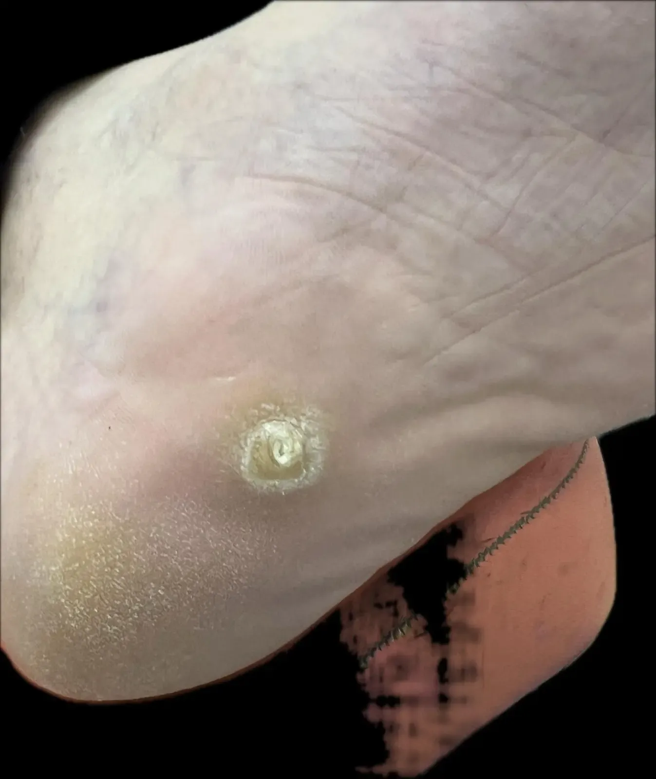 Queratosis plantar intratable antes del tratamiento