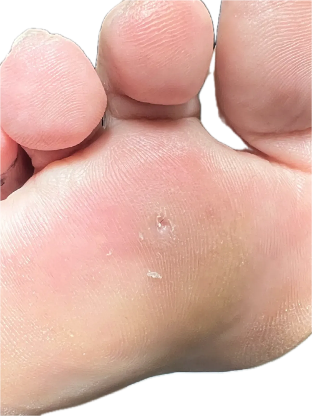 Primer plano de callosidad plantar con punto negro central indicando pelo enclavado en el pie