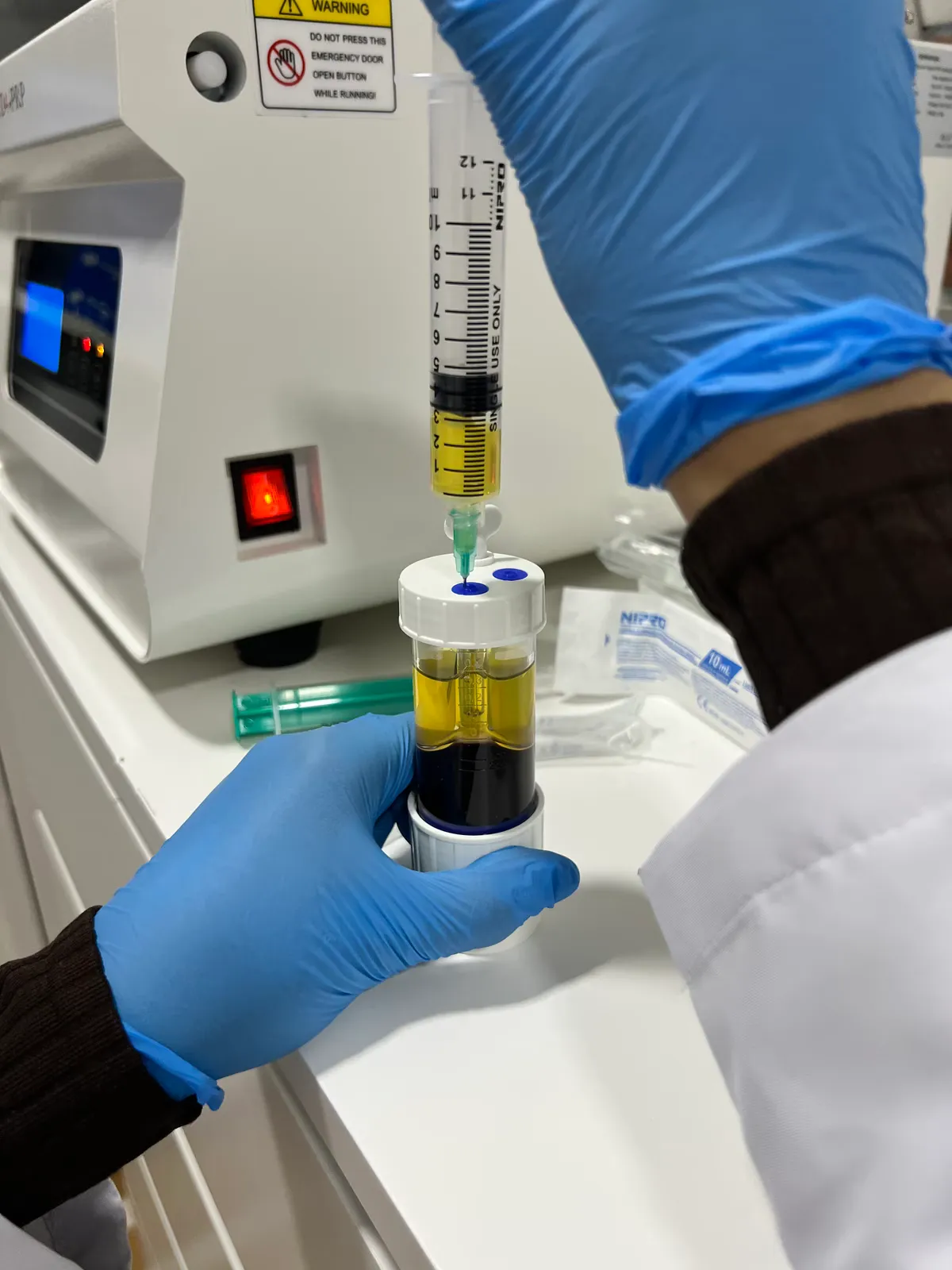 Extracción del plasma rico en plaquetas con jeringa tras la centrifugación, en sistema de técnica cerrada en Centro Podológico Henao Bilbao