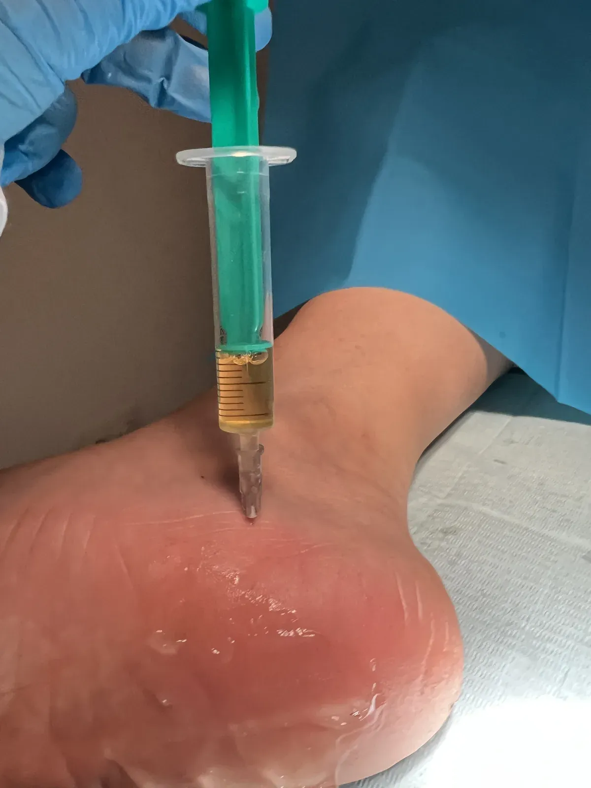 Infiltración de plasma rico en plaquetas en el talón, dirigida al tejido fascial y no al espolón óseo, en Centro Podológico Henao Bilbao