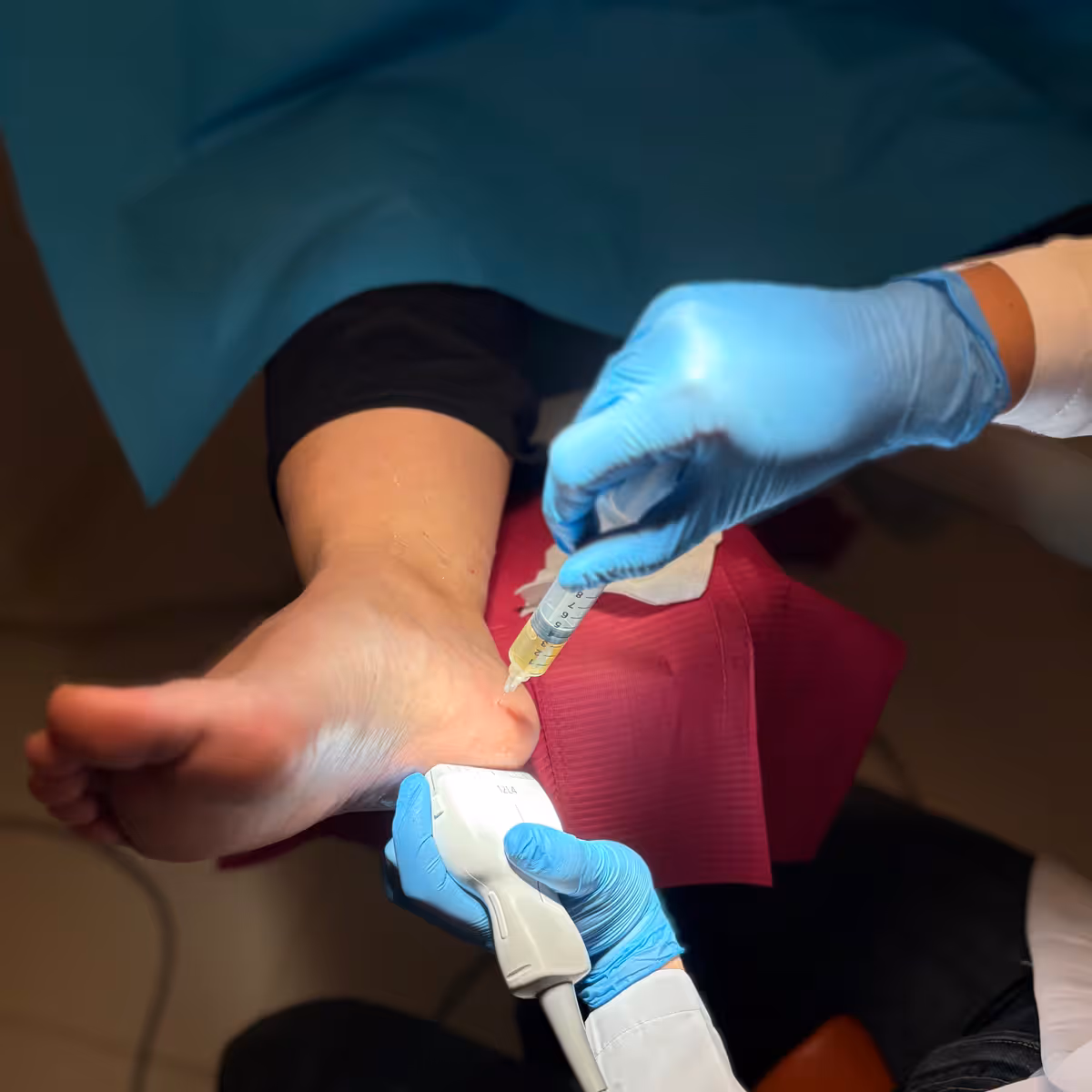 Infiltración ecoguiada de plasma rico en plaquetas para dolor crónico de talón asociado a espolón calcáneo en Bilbao