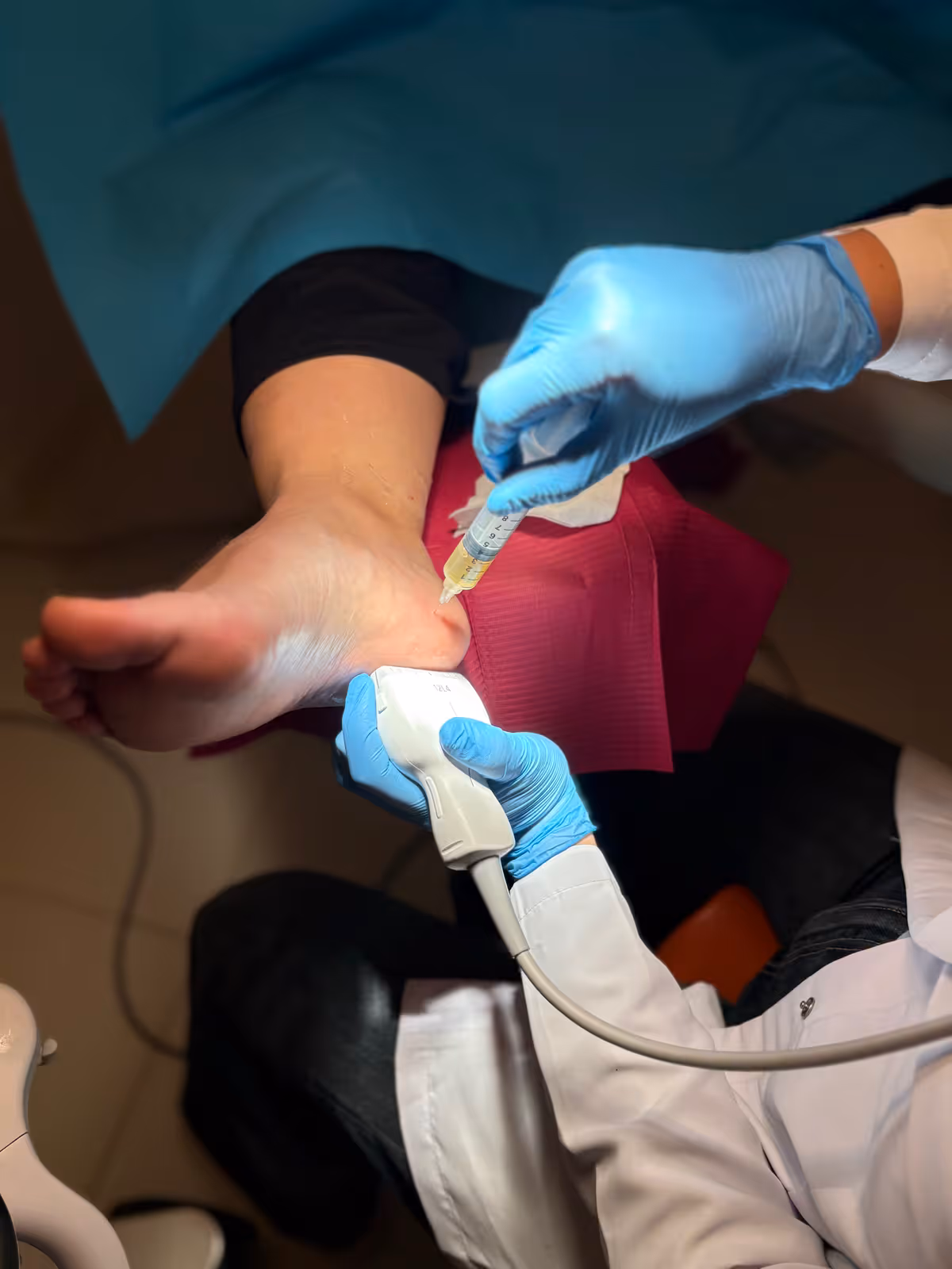 Infiltración ecoguiada de plasma rico en plaquetas en el tobillo, con sonda ecográfica y jeringa de PRP, en Centro Podológico Henao Bilbao