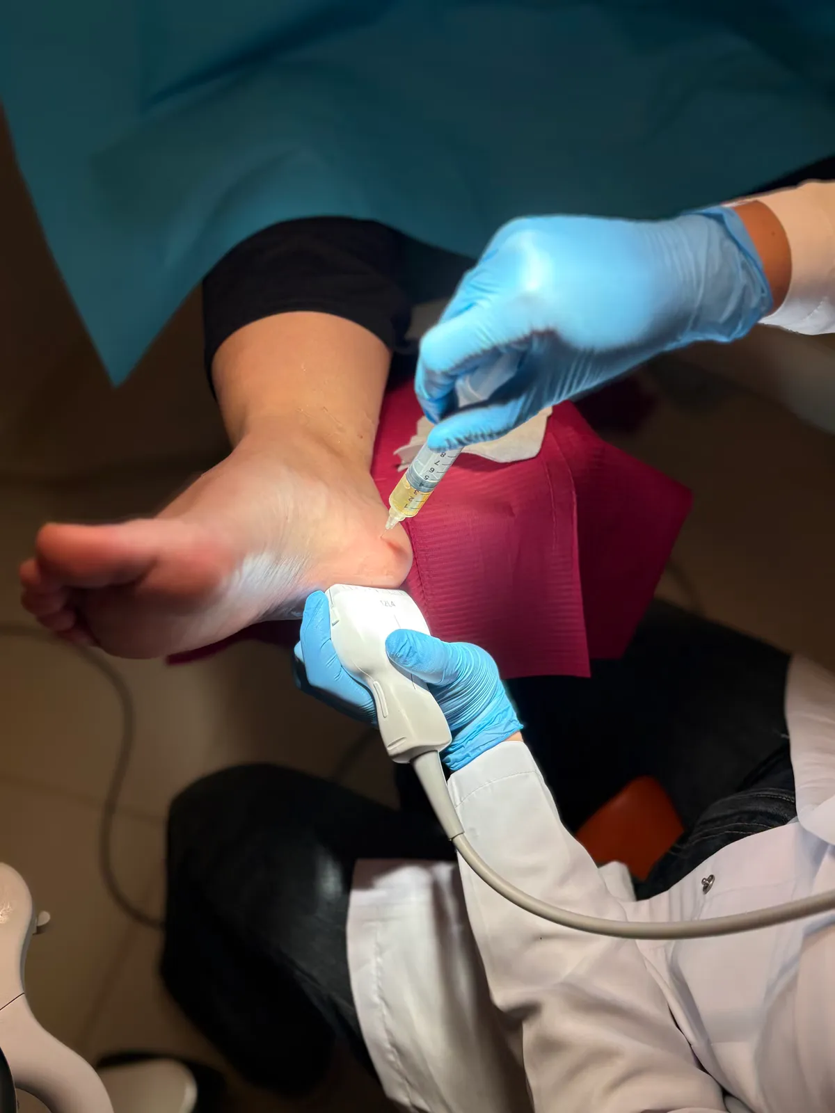 Infiltración ecoguiada de plasma rico en plaquetas en el tobillo, con sonda ecográfica y jeringa de PRP, en Centro Podológico Henao Bilbao