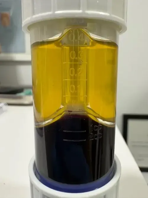 Tubo de plasma rico en plaquetas (PRP) tras centrifugación, mostrando la separación entre el plasma rico en plaquetas en la parte superior y la serie roja en la inferior, en Centro Podológico Henao Bilbao