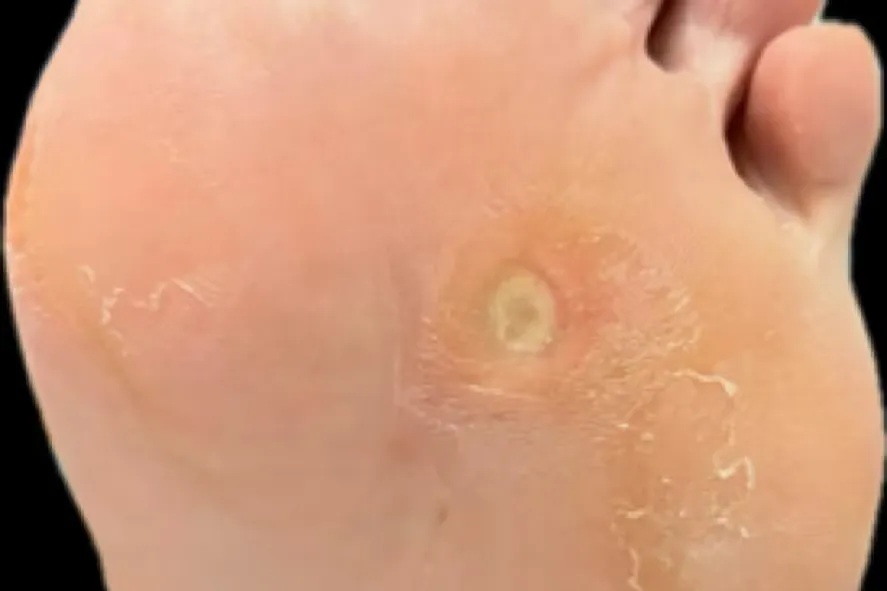 Queratosis Plantar