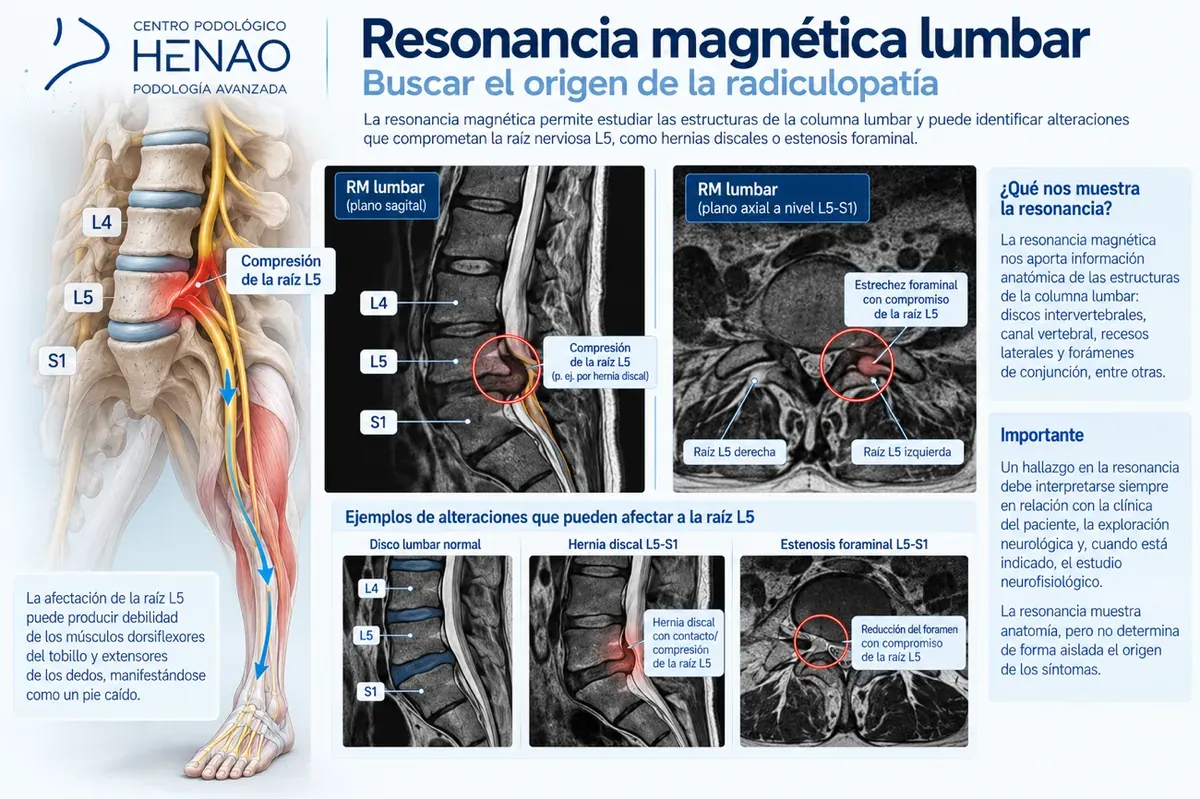 Infografía de la resonancia magnética lumbar y la raíz L5