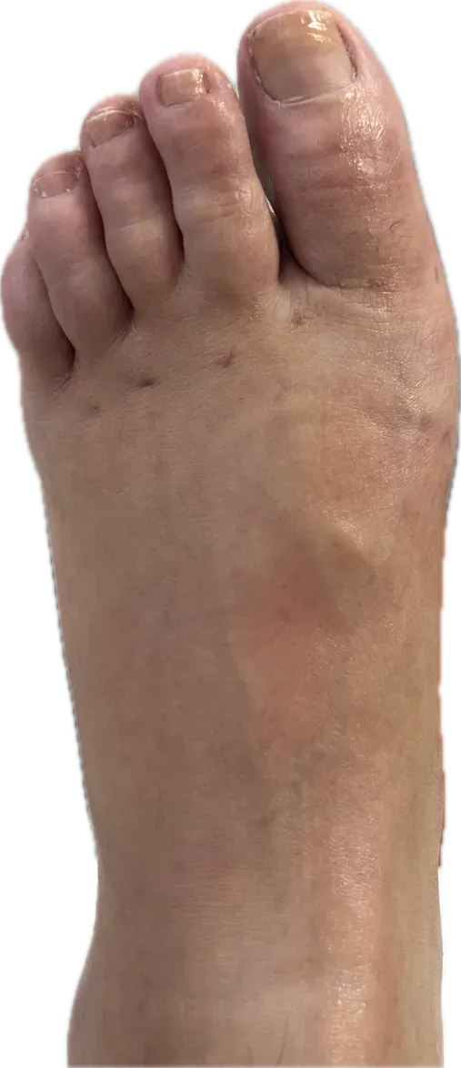 Resultado dorsal postquirúrgico con alineación corregida