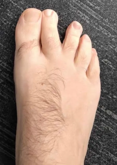 Separación entre segundo y tercer dedo del pie tras traumatismo directo en antepié caso clínico Centro Podológico Henao Bilbao