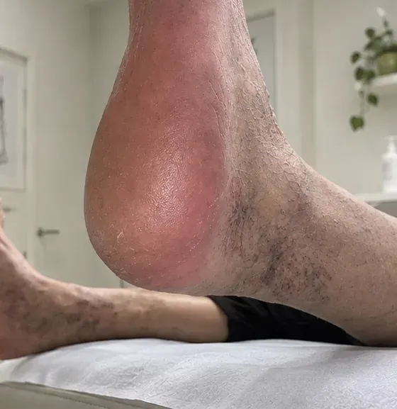 Talón con la piel de aspecto más reparado e hidratado tras el cambio de pauta