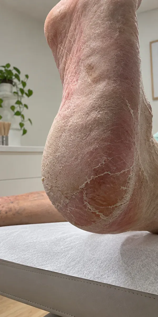 Vista lateral del talón con hiperqueratosis y fisuras en la primera visita