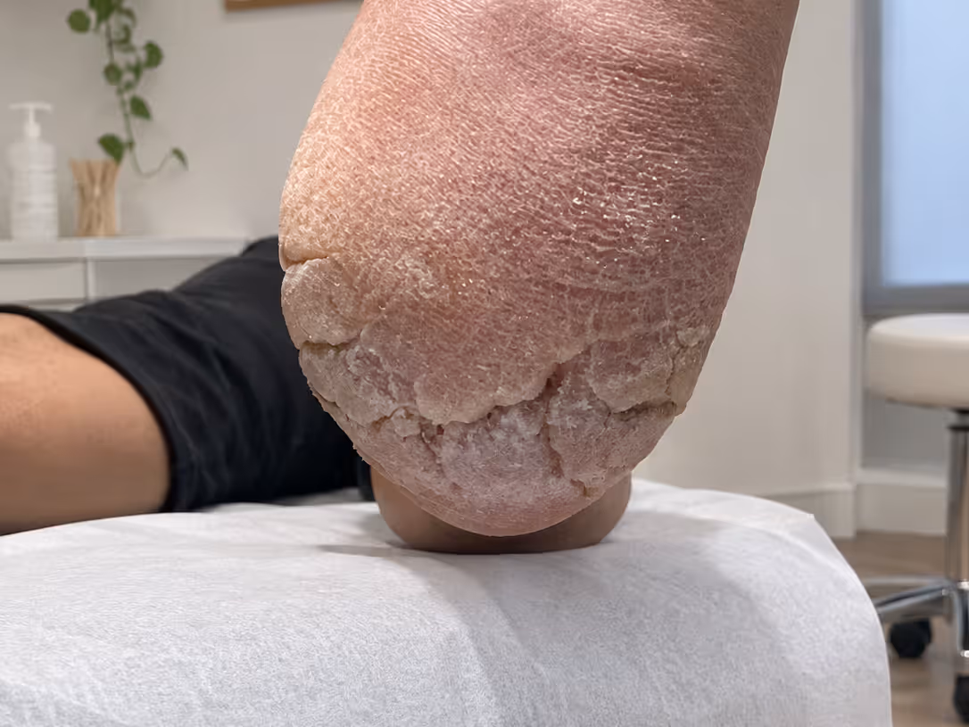 Talón con grietas profundas e hiperqueratosis, fotografía clínica del Centro Podológico Henao
