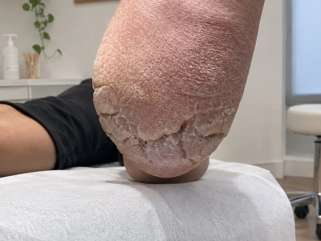 Talón con grietas profundas e hiperqueratosis, fotografía clínica del Centro Podológico Henao