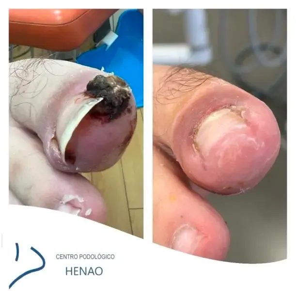 Cirugía láser de uña encarnada — resultado inmediato