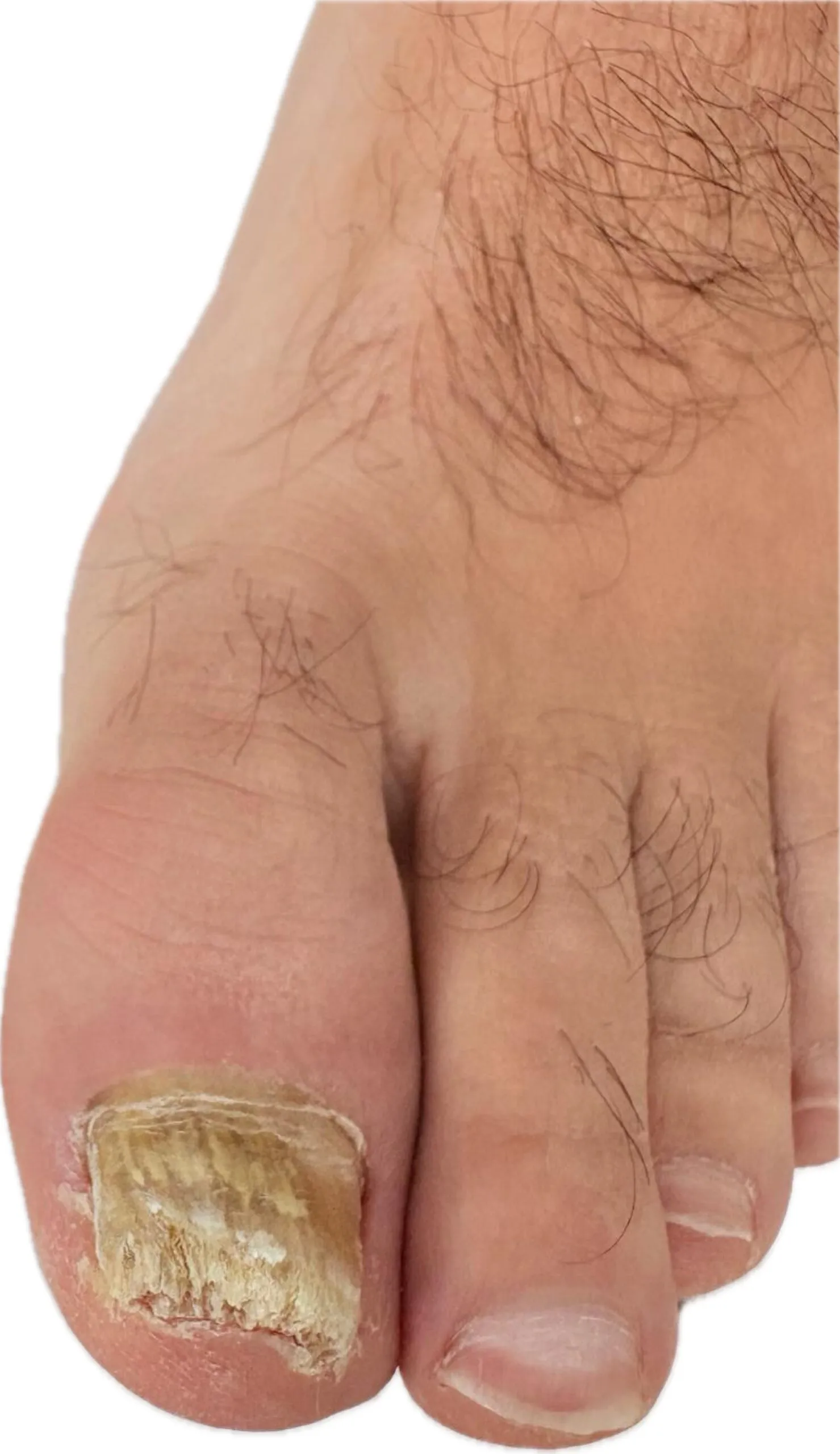 Equipo de ecografía de alta resolución para evaluación de uñas negras