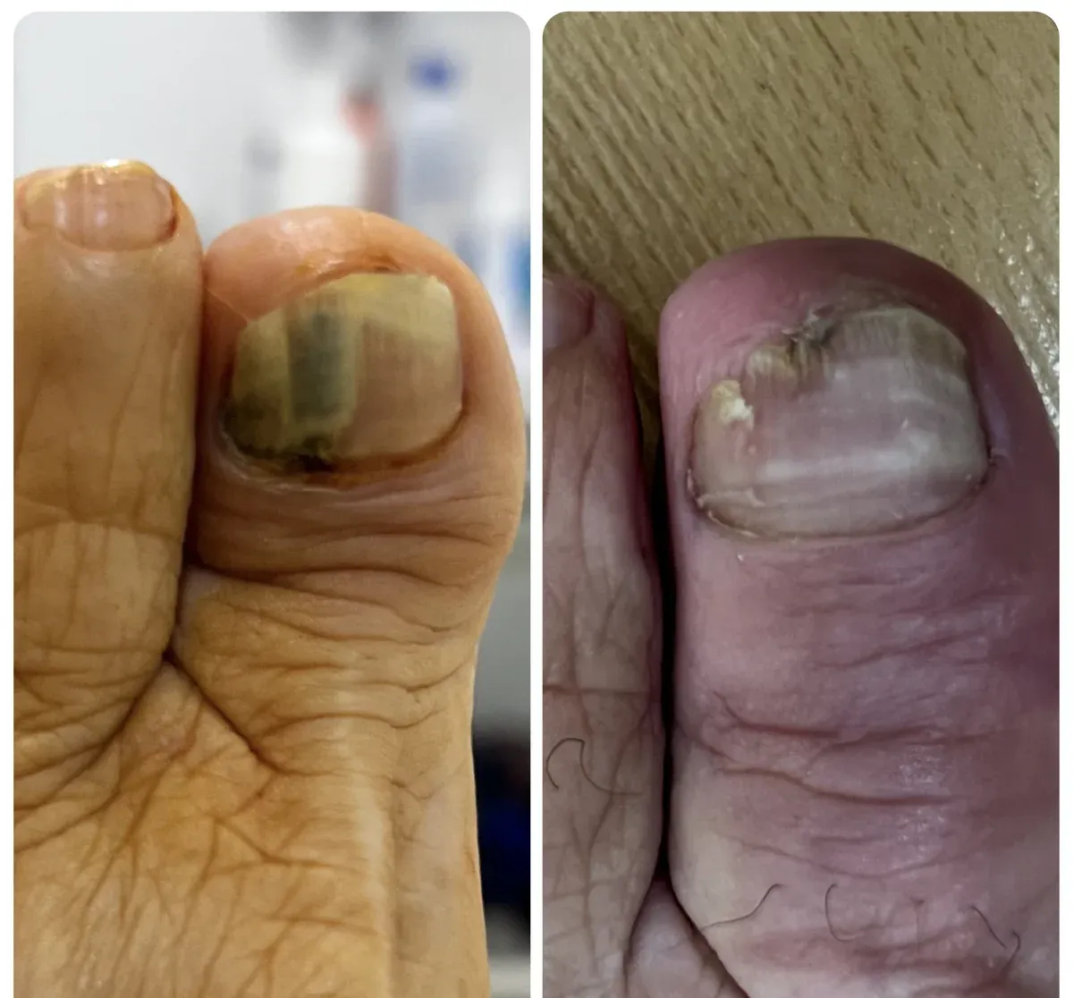 Comparativa de la uña del dedo gordo: a la izquierda, con bandas oscuras y amarillentas; a la derecha, más clara y sin las bandas oscuras, con estrías transversales y el borde libre irregular
