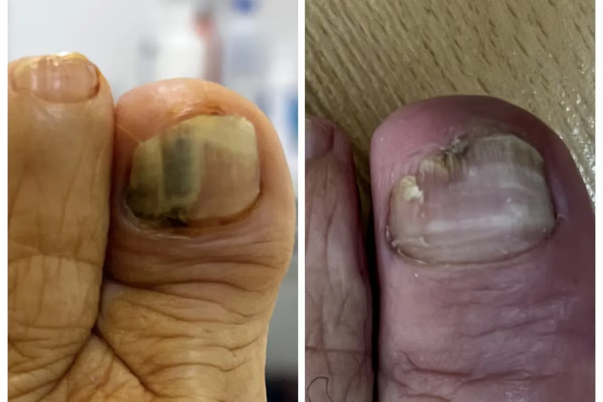 Uña del dedo gordo antes, con bandas oscuras y amarillentas, y en su evolución, más clara, tras la tenotomía en Centro Podológico Henao Bilbao
