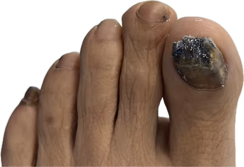 Uña negra voluminosa por exostosis subungueal antes de cirugía en Centro Podológico Henao Bilbao
