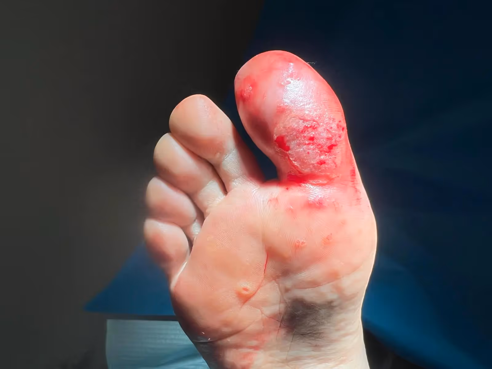 Verruga plantar en mosaico en el dedo gordo antes del tratamiento con técnica Falknor