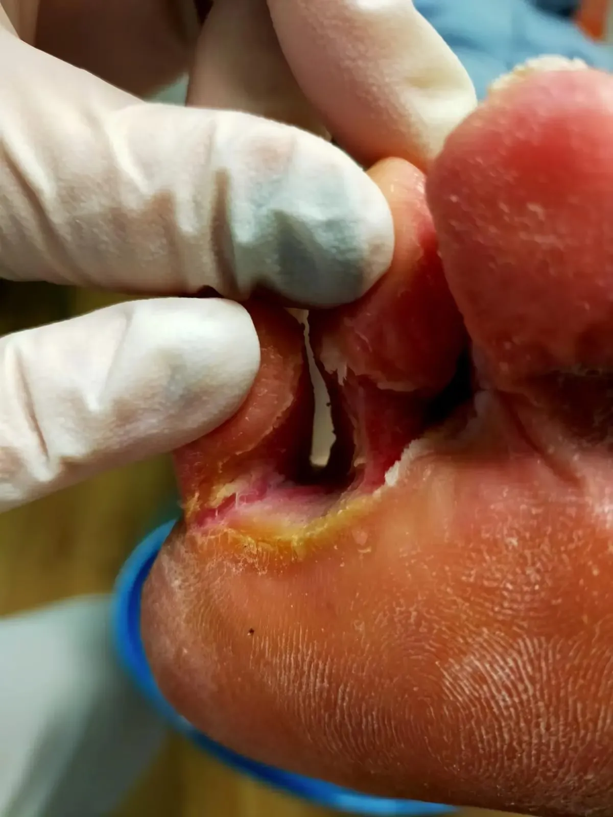 Caso clínico de hongos en los pies en consulta podológica