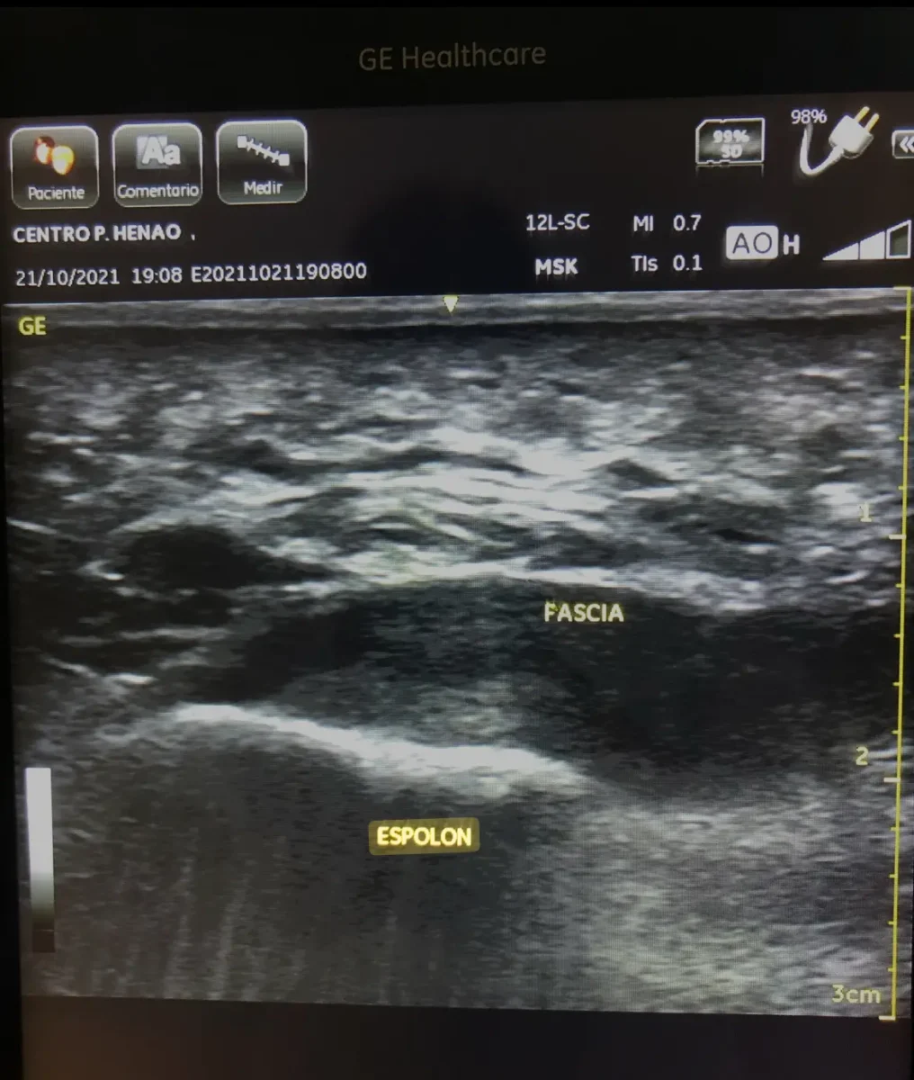 espolon calcaneo podologo bilbao centro podologico henao