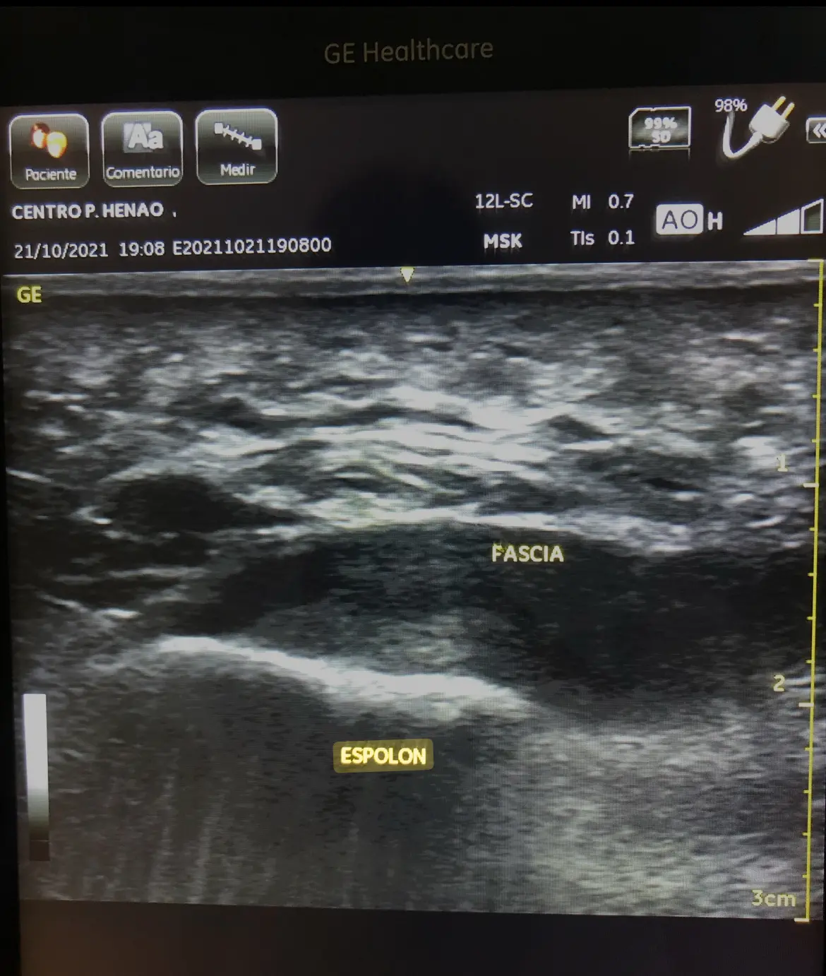 espolon calcaneo podologo bilbao centro podologico henao