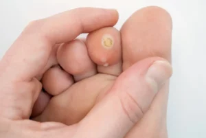 verruga plantar centro podologico henao