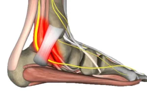 Sindrome Tarso Carpiano
