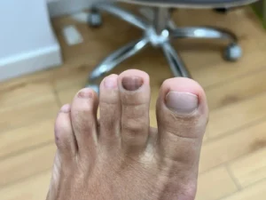 Caso clínico real de melanoniquia evaluado en Centro Podológico Henao, Bilbao. Imagen publicada con consentimiento del paciente.