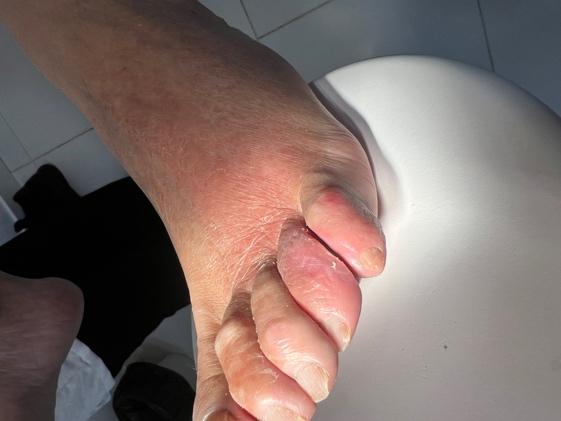 Exploración clínica mostrando úlcera interdigital con maceración severa, eritema y exudado seroso entre los dedos