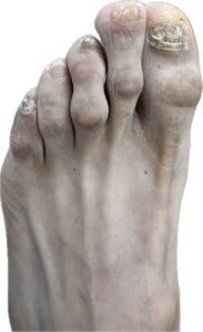 Uña con onicomicosis pigmentada mostrando coloración oscura y engrosamiento