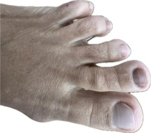 Podóloga realizando exploración clínica de uña negra en consulta