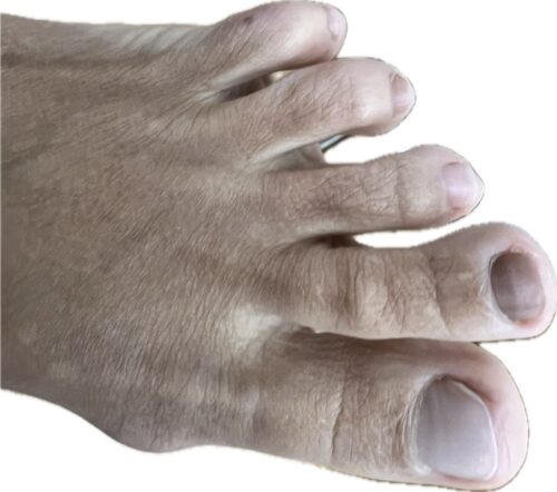 Evaluación clínica melanoniquia uñas negras podólogo Centro Podológico Henao