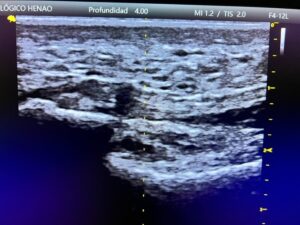 Ecografía musculoesquelética de fascia plantar con engrosamiento y cambios degenerativos en Centro Podológico Henao Bilbao