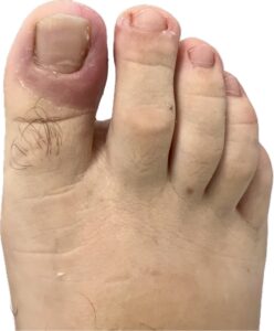 Dedo gordo del pie completamente curado tras cirugía de uña encarnada con uña sana en Centro Podológico Henao Bilbao