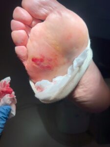 Pie tras técnica de multipunción Falknor para verruga en mosaico en Centro Podológico Henao Bilbao