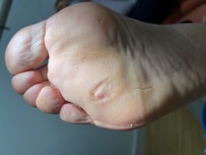 Resolución de verruga plantar en mosaico tras tratamiento con técnica Falknor en Centro Podológico Henao Bilbao